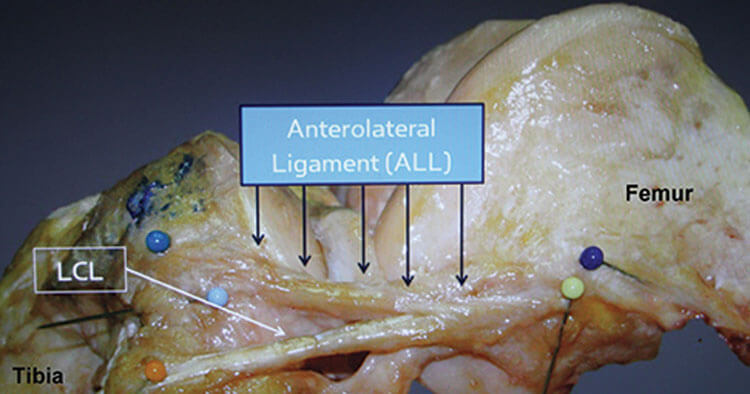 Is Extra-Articular Tenodesis The Future Of ACL Reconstruction Surgery?