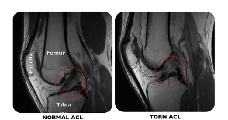 ACL Reconstruction Trends