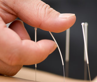 physiotherapy acupuncture dry needling