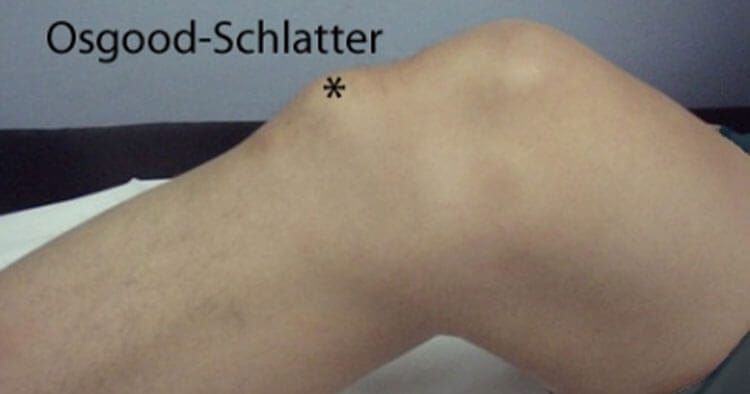 Managing Osgood-Schlatter's Disease