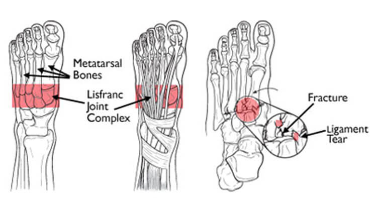 Lisfranc Injury: An Injury To The Midfoot
