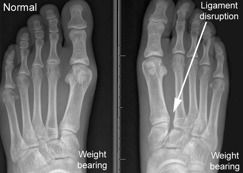 X-Ray Lisfranc Injury