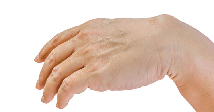 Symptoms And Diagnosis Of Ganglion Cysts