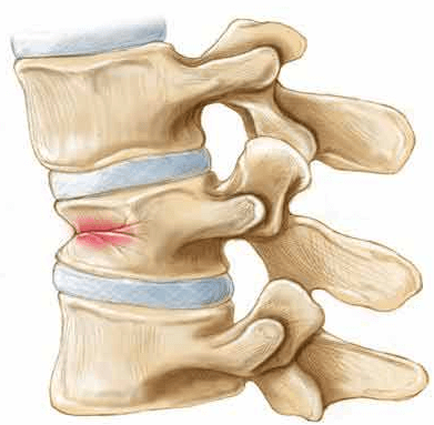 C:\Users\sydneyphysioclinic\Downloads\Saved Pictures\Osteoporotic_fractures.png