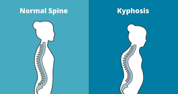 Treatment And Diagnosis Of Upper Back Kyphosis
