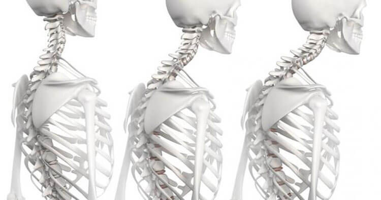 What Causes An Exaggerated Thoracic Spine Kyphosis?