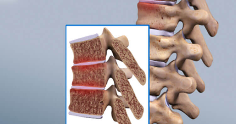 Juvenile Osteochondrosis Of The Spine