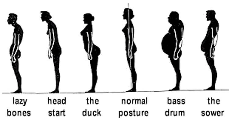 Sway Back Posture: A Common Postural Variation