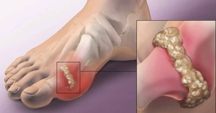 What Is Gout And Who Gets It?
