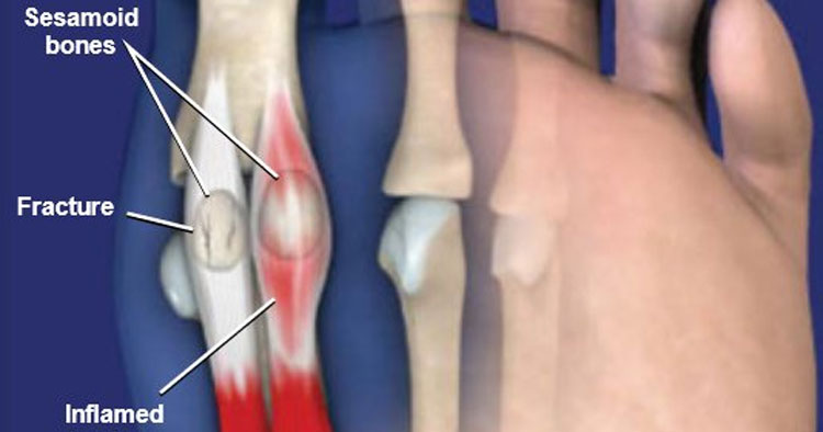 Diagnosis And Treatment Of Sesamoid Injury