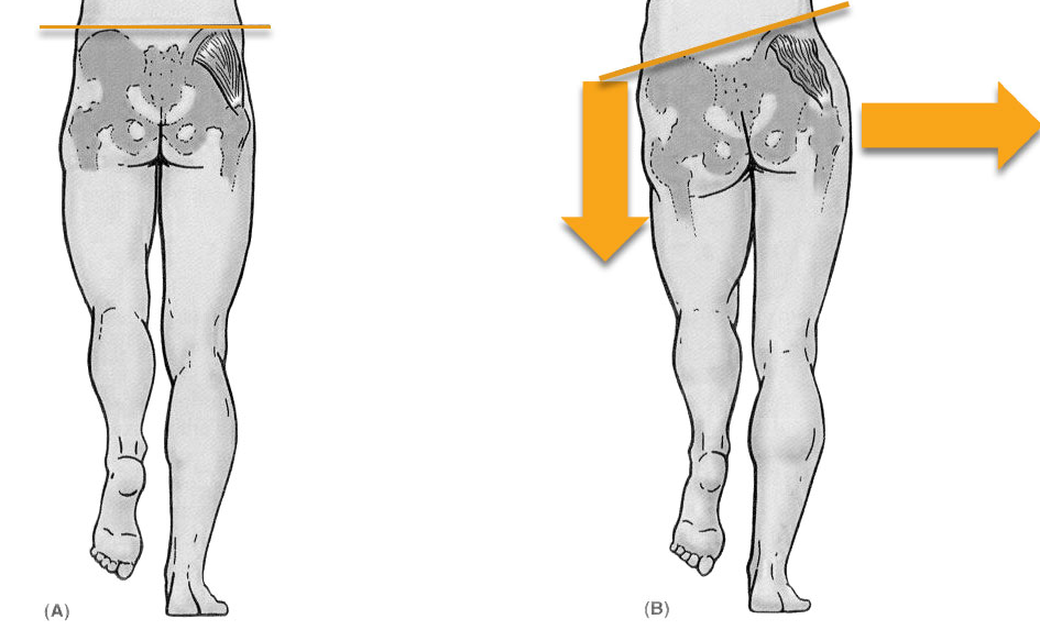 Trendelenburg Gait A Sign Of Poor Hip Function | Sydney Physio Clinic