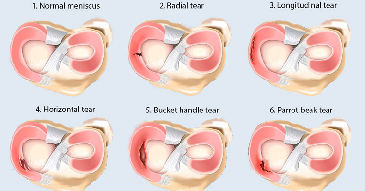 Types Of Meniscus Tear And Their Diagnosis