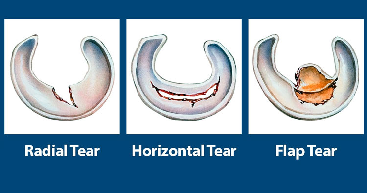 Types Of Meniscus Tear And Their Diagnosis