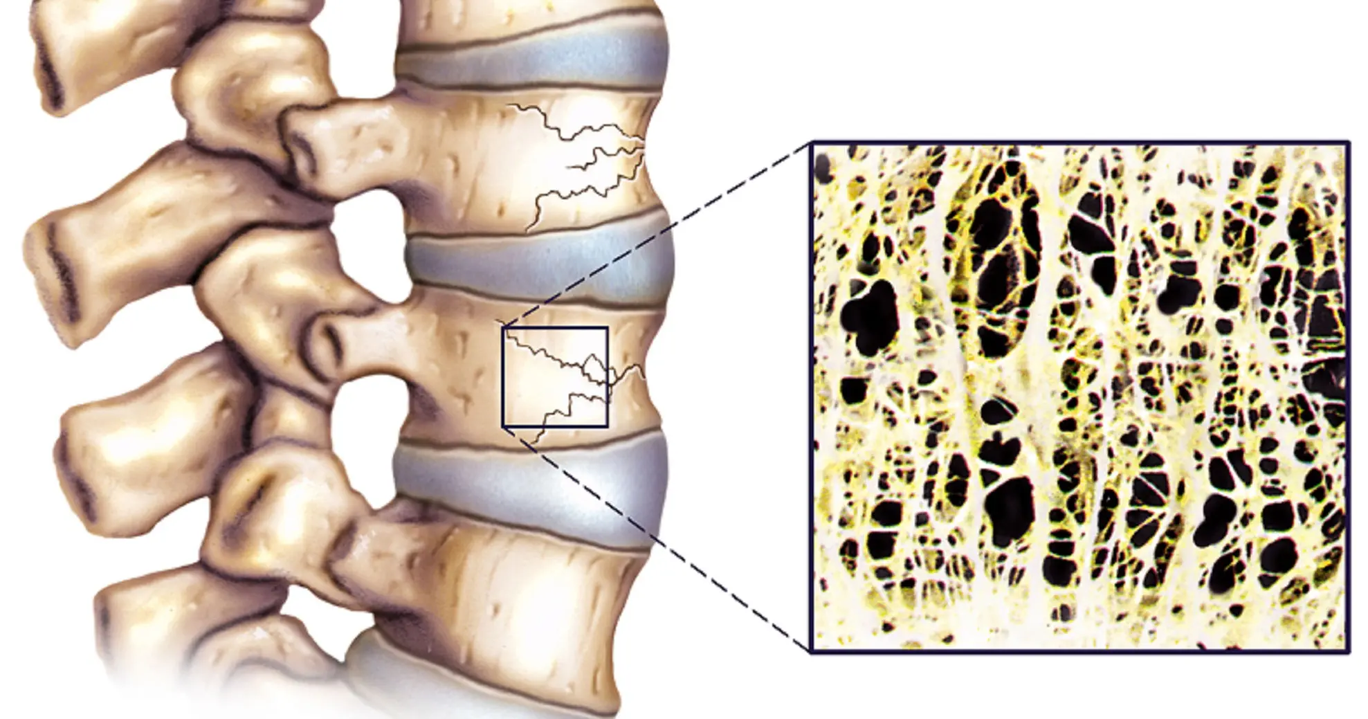 Detecting Osteoporosis