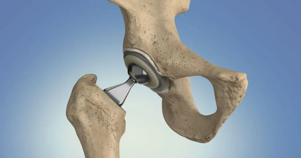 Do I Need A Total Hip Replacement?