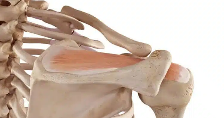 Rotator Cuff Impingement Syndrome Causes